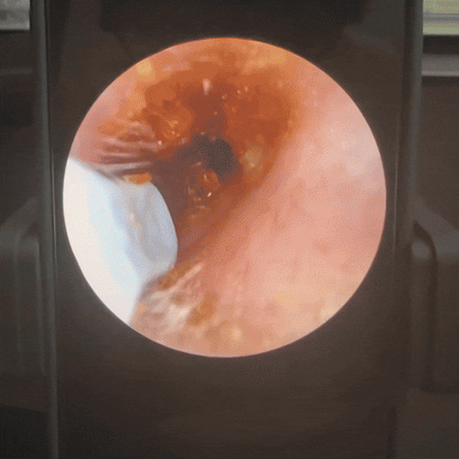 Endoscope Auriculaire